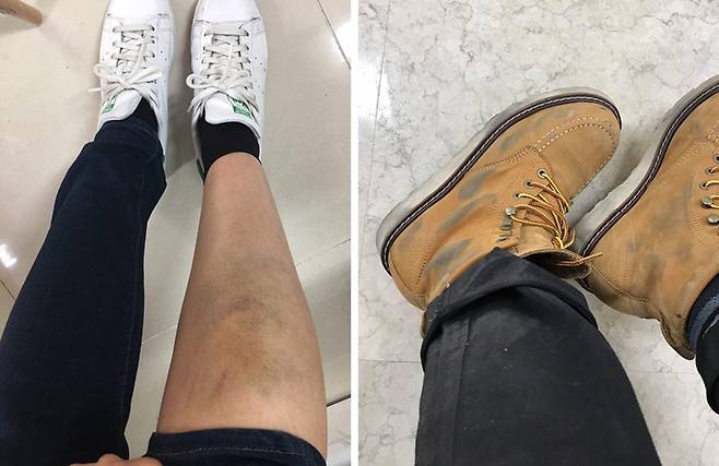 ▲ 박다솔 참세상 기자의 멍든 다리 (왼쪽)와 사진가 정운씨의 신발(오른쪽). 사진=당사자 제공