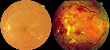 당뇨망막병증 초기(왼쪽)와 중증. 중증으로 악화하면 망막에 출혈이 생겨 실명 위험이 높아진다. [사진 분당서울대병원]