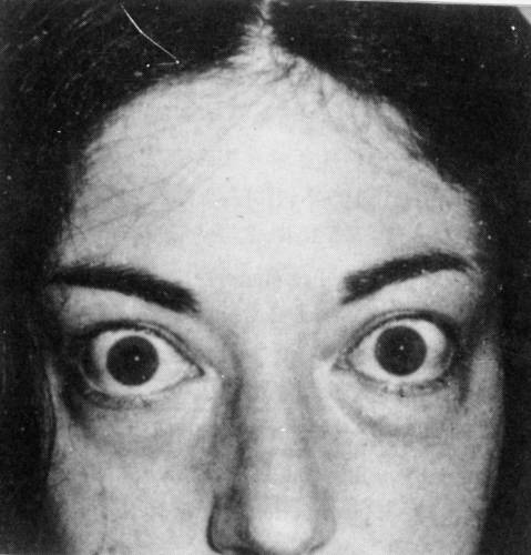 갑상선 기능항진증을 심하게 앓으면 안구돌출증이 나타난다. 약물 치료받기 전의 모습이다. [사진=중앙일보 사진DB]