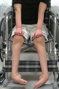 CMT 환자 사진./툴젠 제공