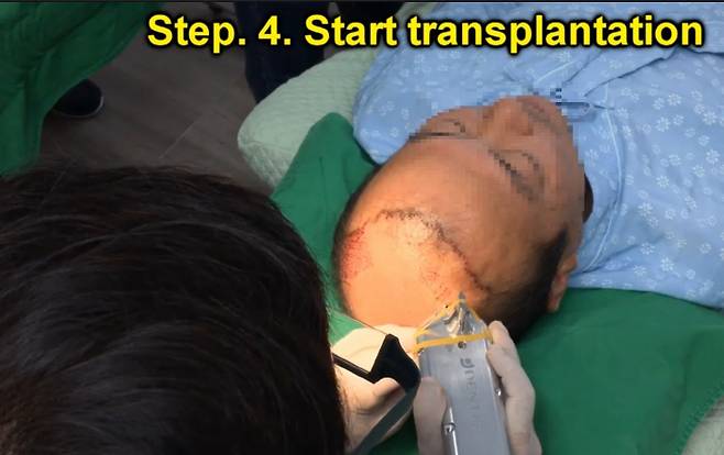 한국전자통신연구원 연구진이 한 탈모 환자의 정수리 부분에 자동 식모기를 사용해 모낭을 심는 임상실험을 진행하고 있다. <사진 제공=한국전자통신연구원>