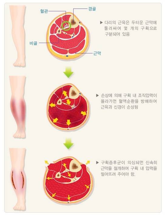 구획증후군의 개념도. [출처 보건복지부·대한의학회]