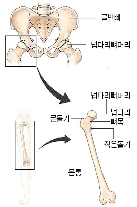엉덩관절(고관절)과 넙다리뼈(대퇴골). 골다공증에 걸리면 넙다리뼈의 윗부분이 잘 부러진다.
