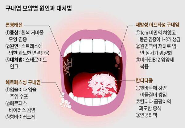 [헬스조선]구내염 모양별 원인과 대처법/사진=헬스조선 DB