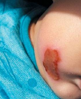 ‘약 안 쓰고 아이 키우기’(안아키) 카페에 올라온 화상을 입은 어린이 사진. 이 사진을 올린 회원은 ‘카페 지침대로 뜨거운 물로 찜질하고 햇볕을 쬐어 줬는데 별 효과가 없다’는 내용의 글을 남겼다. /안아키 캡처