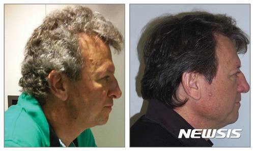 【시카고=AP/뉴시스】 한 폐암 환자가 스페인 연구진이 개발한 한 항암 치료 약물을 복용한 이후 흰머리 대신 갈색머리가 자라나는 신기한 경험을 했다. 사진은 약물 복용 전후의 모습. 2017.07.22.