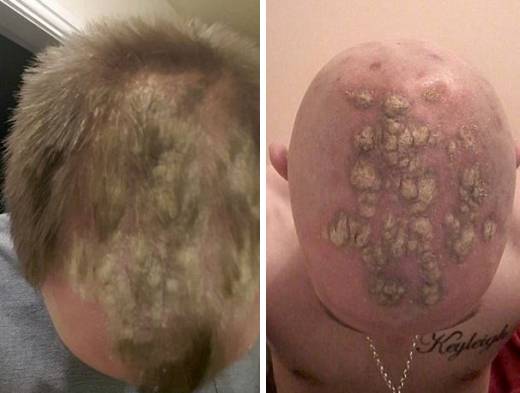 하디는 유니레버사의 VO5를 사용한 이후부터 두피가 가렵고 따끔거리기 시작했다.