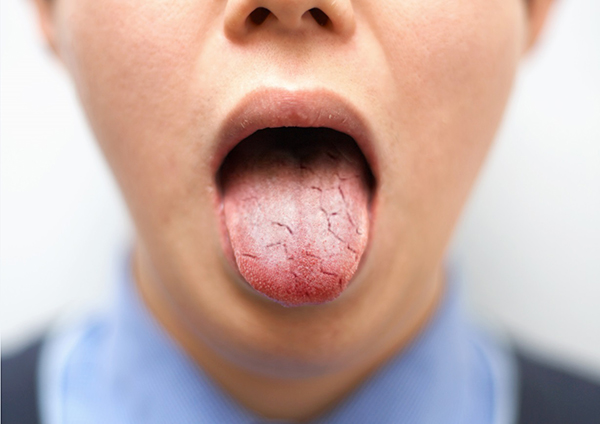 혀의 상태는 구내염·구강건조증·전신질환 등 여러 질병에 걸린 신호일 수 있다/사진=헬스조선 DB
