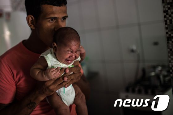 호주에서 임신부 1명이 지카(Zika) 바이러스 확진 판정을 받았다. 지카 바이러스는 신생아의 두뇌와 두개골이 비정상적으로 작은 선천성 기형 '소두증' 유발과 관련있는 것으로 의심받고 있다. 사진은 소두증을 앓고 있는 아기. © AFP=뉴스1