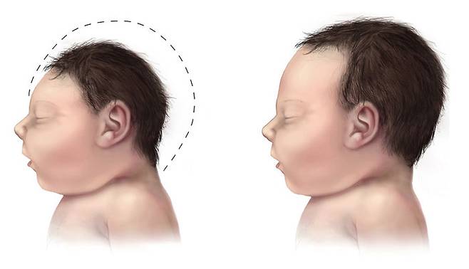소두증 아동(왼쪽). 출처/ 미국 CDC