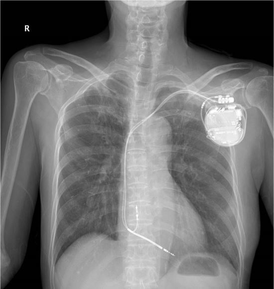 삽입형 자동 제세동기를 가슴 부위에 삽입한 환자의 X선 촬영 사진. 서울아산병원 제공