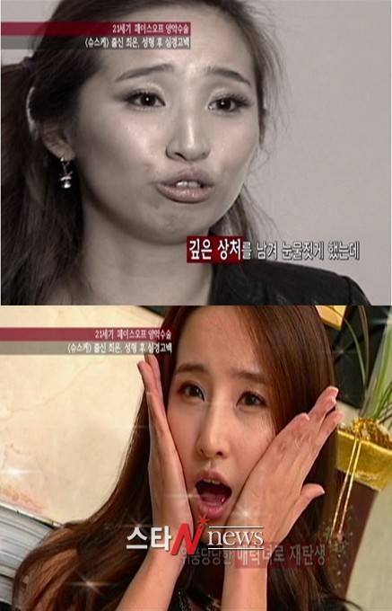 최은 양악수술 후 첫 방송출연, '아나운서느낌 물씬'