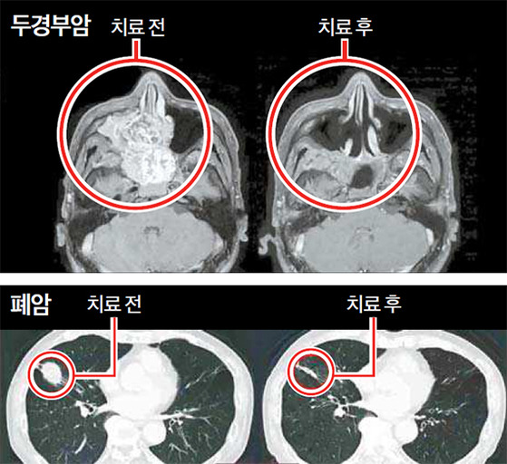 중입자선 치료를 받은 두경부암 환자와 폐암 환자의 CT 사진.