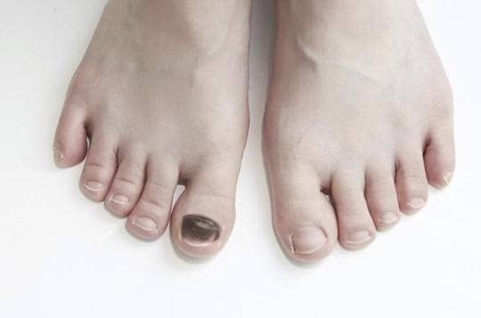 흑색종은 검붉은 반점이 불규칙하게 번질 때 의심할 수 있다. /사진=헬스조선 DB​