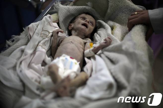 영양실조로 치료받는 시리아 아기 '사하르'. © AFP=뉴스1
