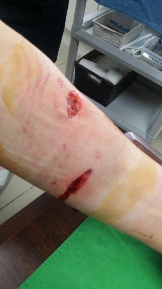 지난 8월11일 직불금 조사에 나섰다가 대형견에 물린 전모씨의 상처. 왼팔 근육이 끊어지는 등 4곳을 물려 두 달이 넘도록 재활 치료를 받고 있다.