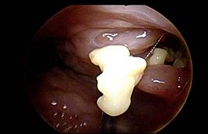 양치질을 해도 입냄새가 사라지지 않는다면 편도결석을 의심해야 한다./사진=헬스조선DB