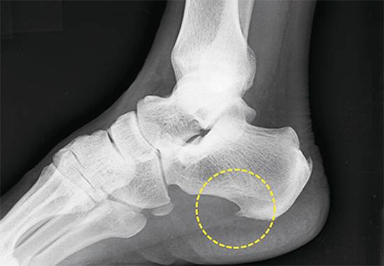 족저근막염은 발 과부하 탓에 생기는 족부질환이다. 족저근막 손상으로 ‘골극’이 생겨날 경우 수술까지 고려해봐야 한다. 사진은 골극이 생겨난 환자 X-레이 촬영 화면이다. 점선 속 가시처럼 돋아난 부분이 골극이다. <서울대병원 제공>