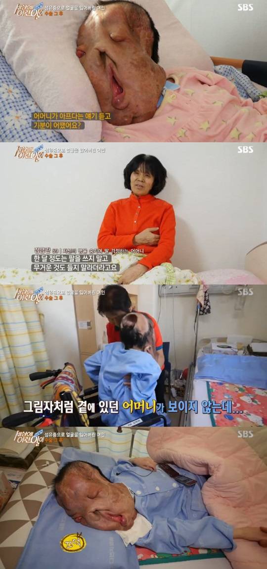 세상에 이런 일이 신경섬유종