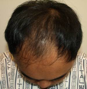 유전에 의한 탈모 사례 5. 이마 전체의 탈모가 정수리 쪽으로 이어져 M자보다는 C자에 가깝다.