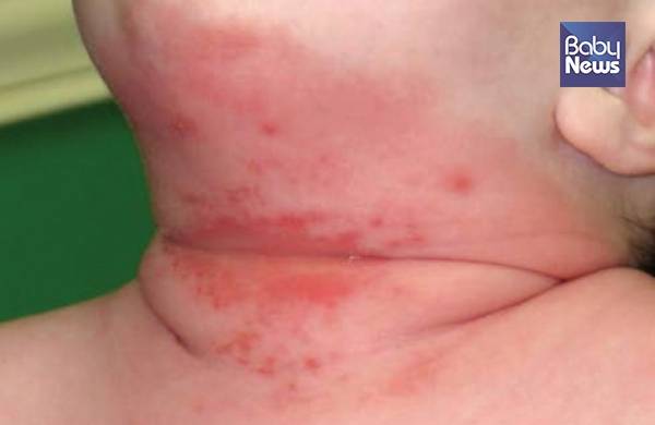 칸디다 피부스침증(사진 7). ⓒ박준수