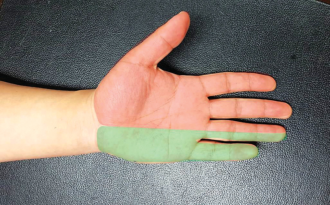 배트맨 자세(위 사진)와 말초신경 압박으로 저리는 부위. 붉은색 부위가 저리면 손목터널증후군, 푸른색 부위가 저리면 팔꿈치터널증후군을 의심한다. © 사진=유재욱 제공