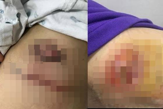 한예슬이 공개한 상처부위 모습/사진=한예슬 인스타그램