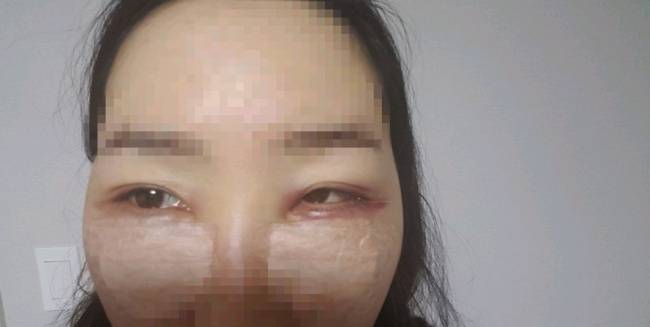 성형수술 부작용으로 사시 판정을 받은 김 모씨. 김 씨는 병원 측에 항의하러 갔지만 병원은 경찰을 불렀다. [독자제공]