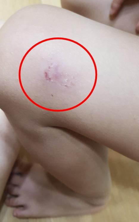 강아지에 물린 A군의 허벅지 [독자 제공 = 연합뉴스]