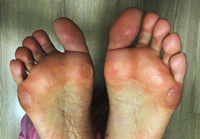 무지외반증과 동반되는 발바닥 굳은살. 엄지발가락이 변형되면 하중이 발바닥으로 이동, 굳은살이 박일 수 있다.