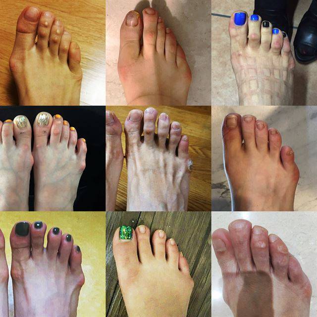 무지외반증과 비슷한 증상이 새끼발가락에 생기는 소건막류 의심 사례들.