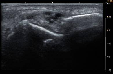 발목인대손상 초음파소견. [사진 유재욱]