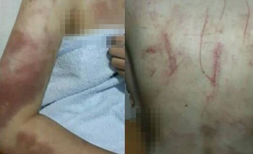 A양이 폭행 당한 부위. 이하 A양 지인 제공