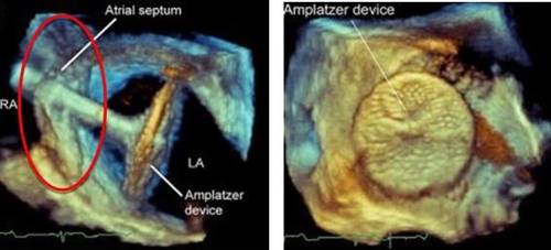 심방중격결손(빨간 원) 부위에 대한 경피적 중재 시술 [강남세브란스병원 제공=연합뉴스]