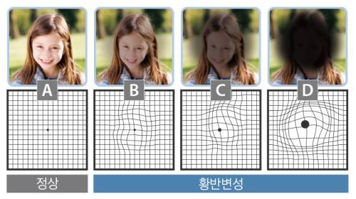 황반변성은 실명질환 중 하나로 최근 여러 연구를 통해 식생활이 황반변성의 발생과 진행에 중요한 역할을 한다고 알려졌다.