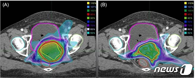 기존에 시행했던 3차원 입체 조형치료(3D CRT, 3dimensional conformal radiotherapy)와 세기 조절 방사선치료(IMRT)를 비교한 결과(왼쪽부터) IMRT가 자궁경부암 부위에 더 효과적으로 조사됐다. © News1