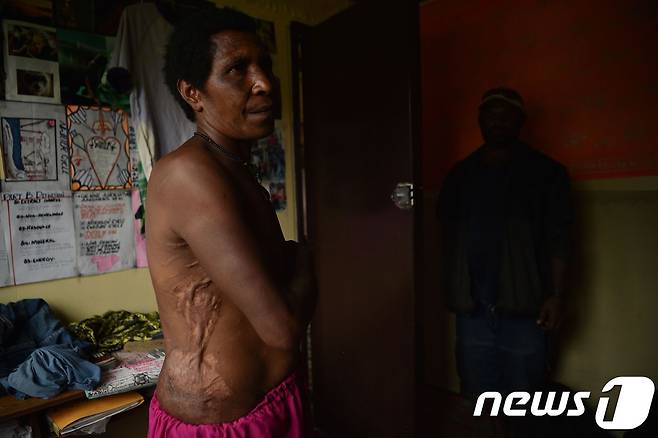 파푸아뉴기니에서 마녀로 몰려 집단 폭행을 당한 55세 여성이 2018년 11월 자신의 상처를 보여주고 있다. © AFP=뉴스1