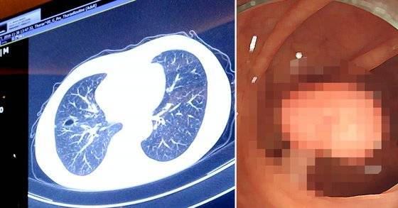 대장암 검진. [중앙포토]