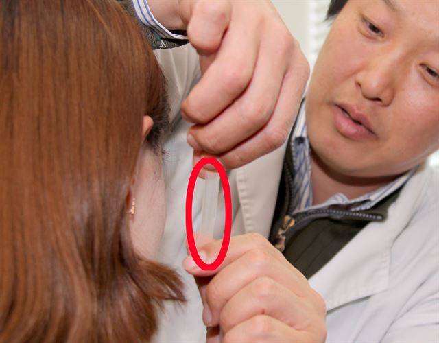 류경석 성형외과 전문의는 “의료용 테이프를 미용목적으로 피부에 오랫동안 부착할 경우 피부 장력으로 인한 피부손상 및 트러블이 일어날 수 있다”고 말했다. 내눈에꽃의원 제공.