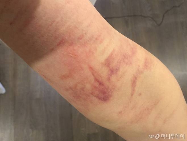 뭔지 알 수 없게 나왔지만, 기자의 팔이다. 맘처럼 안 되는 몸을, 맘처럼 쓰려다 보니 몸에 상처가 이렇게 났다./사진=남형도 기자