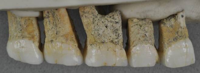 이번에 발굴돼 연구된 위턱 쪽 치아들이다. 특성 분석 결과 치아는 현생인류와 비슷한 면이 있는 것으로 나타났다.  사진제공