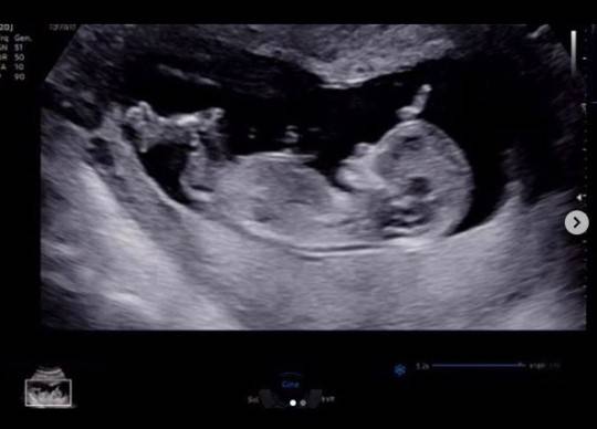 ▲ 김영은이 지난 1일 초음파 사진을 게재했다. 출처l김영은 SNS