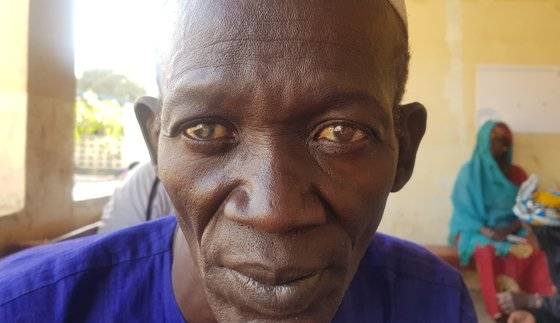 오른쪽 눈동자가 겉보기에도 하얗게 변해 앞이 거의 보이지 않는 상황이었던 라미 산. 진료결과 백내장이 아닌 각막반흔(Corneal scar)이었다. 라미 산처럼 한국의료팀이 손을 쓸 수 없어 그냥 집으로 돌아가야하는 안타까운 상황도 있었다. 김지아 기자