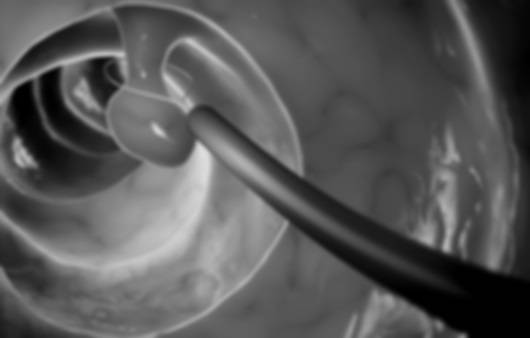 대장내시경 검사 용종 제거