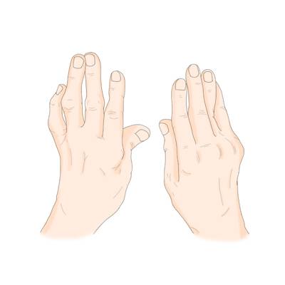 류머티즘 관절염 [출처: 삼성서울병원]