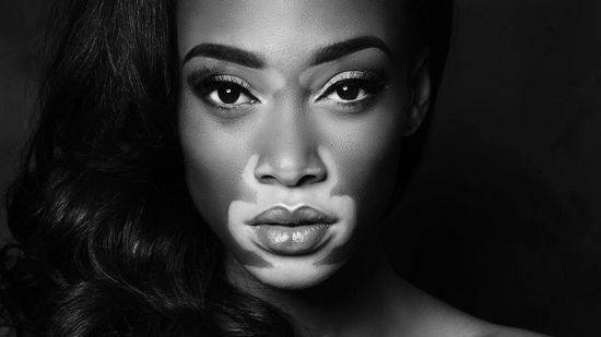 [캐나다 출신의 패션 모델 위니 할로우는 백반증을 앓고 있지만 이를 극복하고 모델로 맹활약하고 있다.위니 할로우 페이스북 캡처]