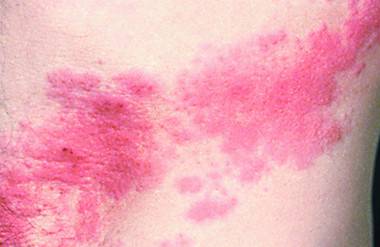 대상포진. 국민일보DB