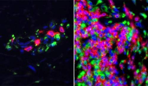 대표적 자가면역 질환인 루푸스병 합성 코르티코스테로이드 제재는 면역 억제 작용을 해 자가면역질환에 많이 쓰인다.  루푸스병도 하나의 자가면역 질환이다. 오른쪽 사진이 면역계 유전자가 활성화된 루푸스 환자의 피부 조직 샘플.  [예일대 의대 천 랩 제공/ 재판매 및 DB 금지]