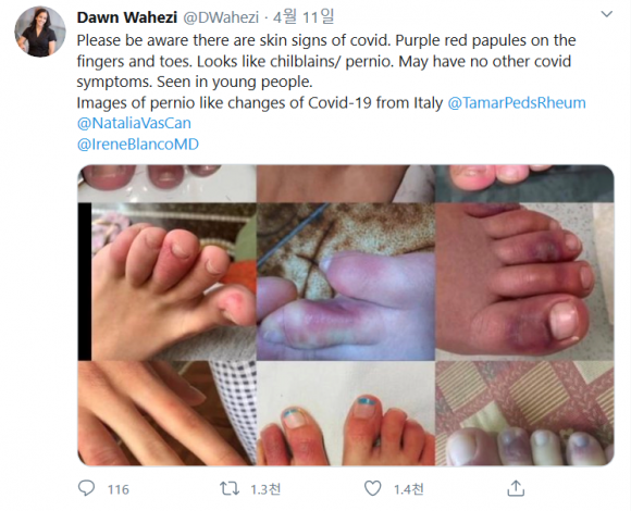 [사진= 소아 류마티스 전문의 Dawn Wahezi 박사가 '코로나 발가락' 사례들을 트위터에 공유했다.]
