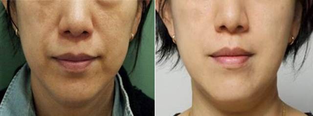 최근 코로나19 여파로 본인과 가족의 건강을 찾는 움직임이 활발하다. 특히 노화의 대표격인 주름 제거에 대한 관심이 높아지고 있다. 사진은 주름을 없애기 위해 실시한 실리프팅 시술 전(왼쪽)과 후.